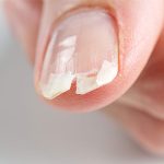 Nail Breaking Problems: Protect Nails From Repeated Damage