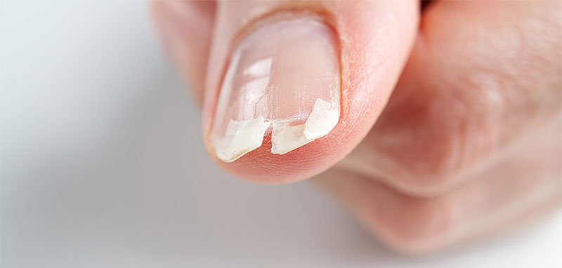 Nail Breaking Problems: Protect Nails From Repeated Damage